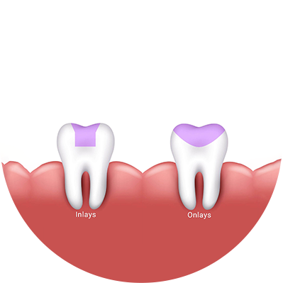 What is a ceramic inlay or onlay?